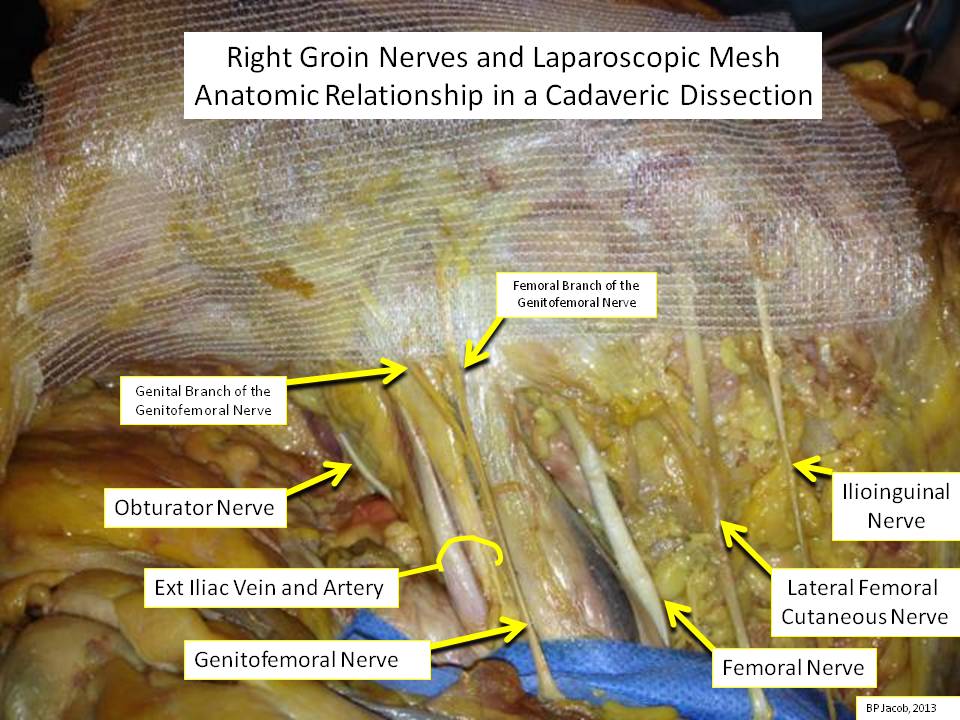 What are symptoms of problems with the mesh used in hernia surgery?