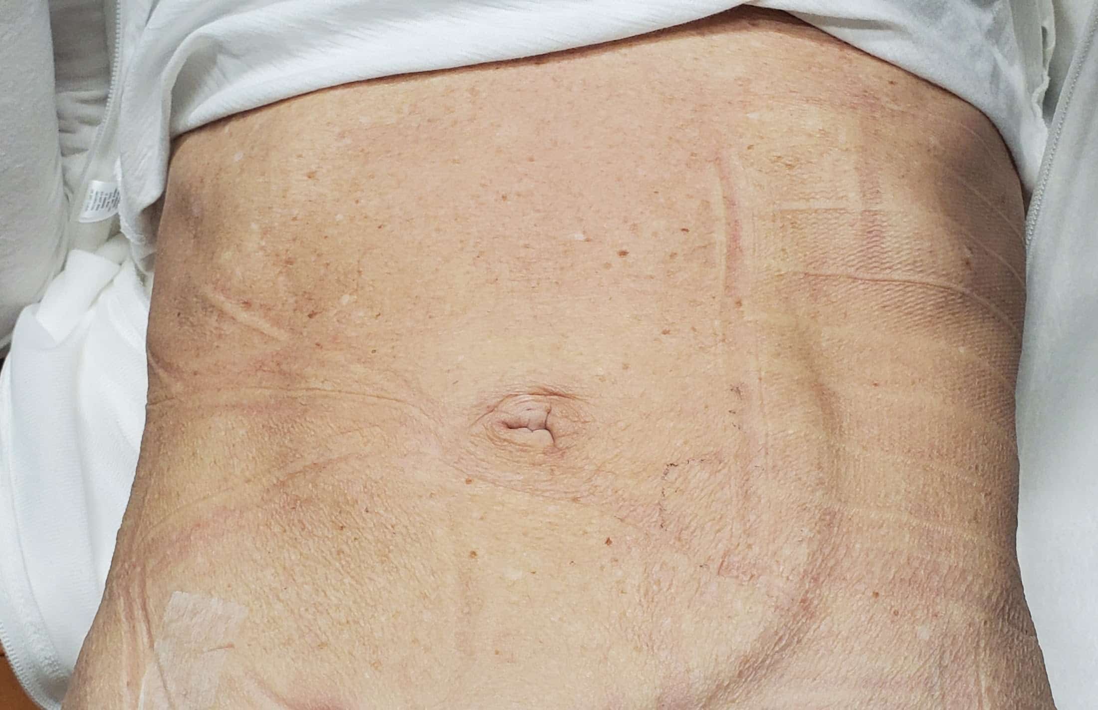 bare stomach after diastasis recti repair surgery, bulge no longer present