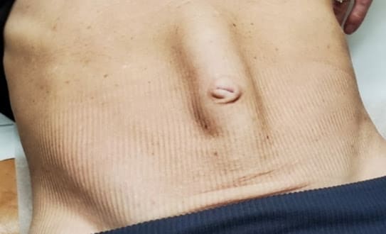 A view from umbilical hernia accompanied by diastasis recti and