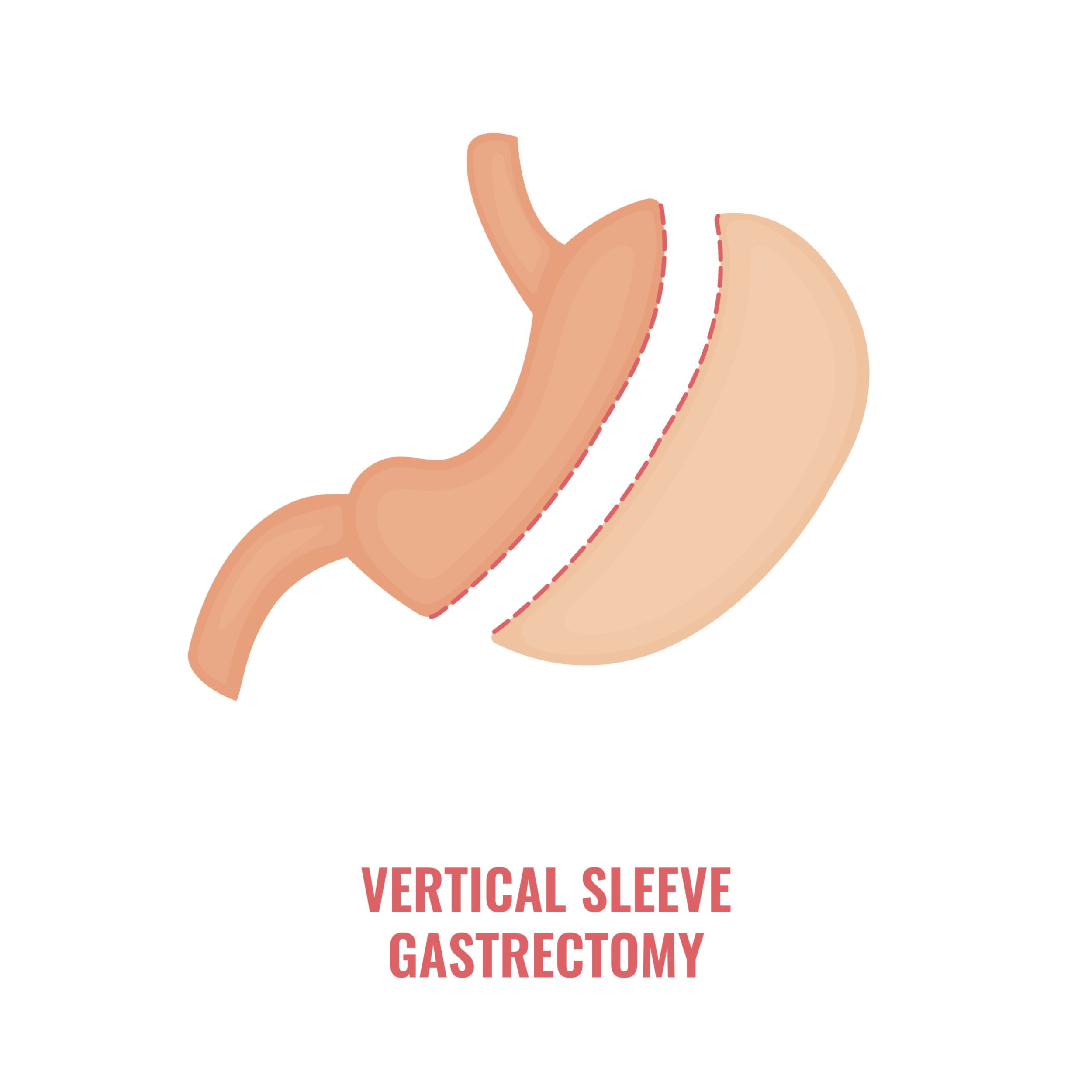 Vertical sleeve gastrectomy New York NY