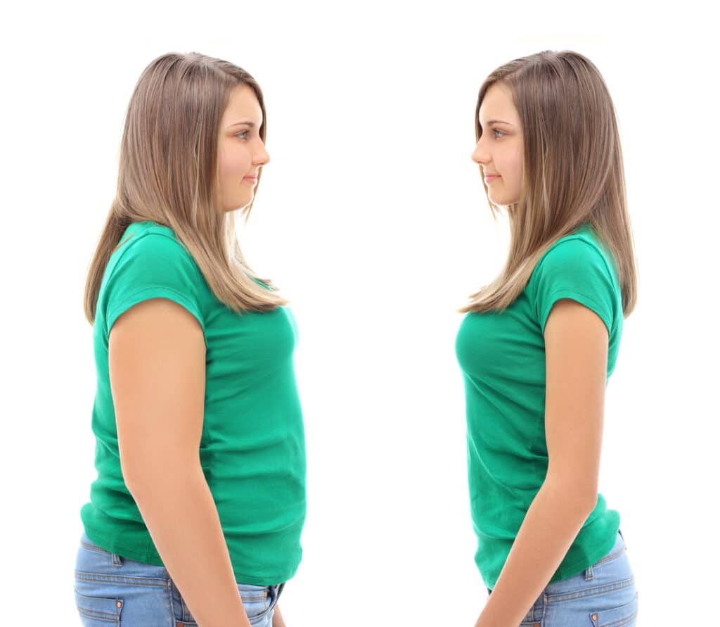 Revisional Weight Loss Surgery New York, NY NYC Hernia