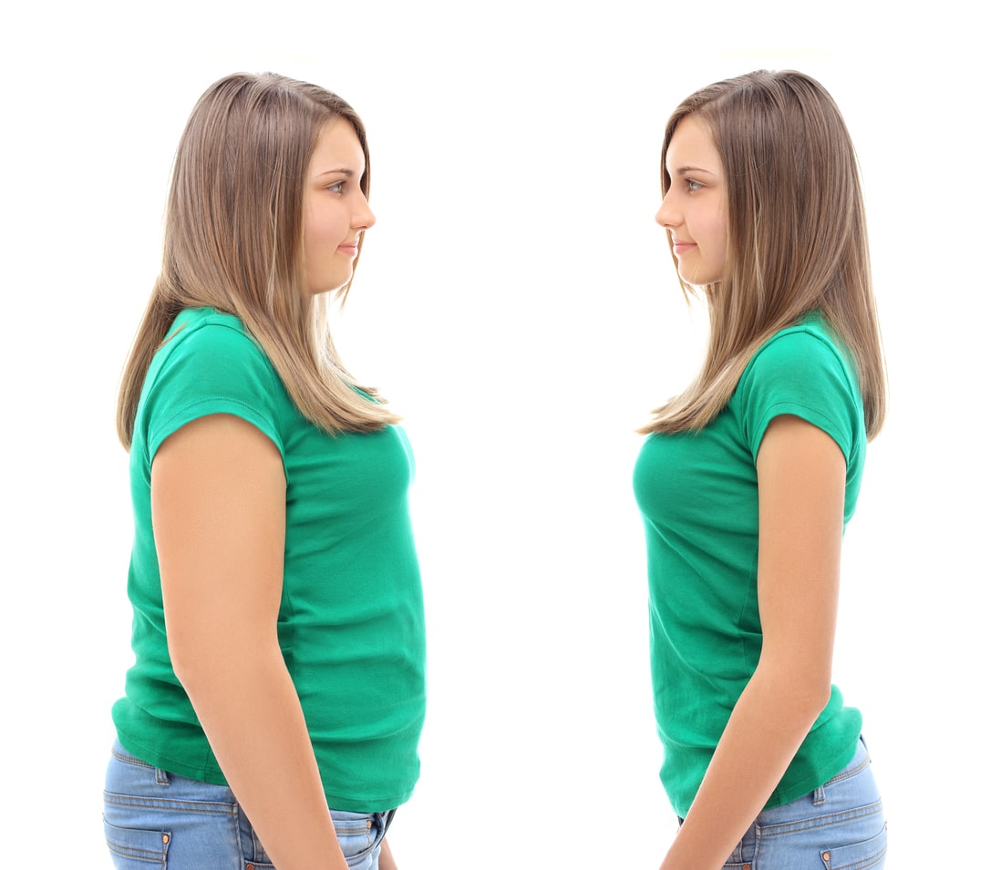 Revision weight loss surgery New York NY