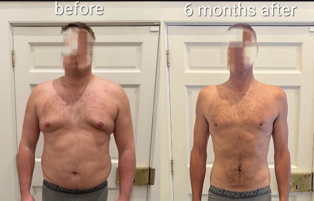 Before After weight loss surgery New York NY