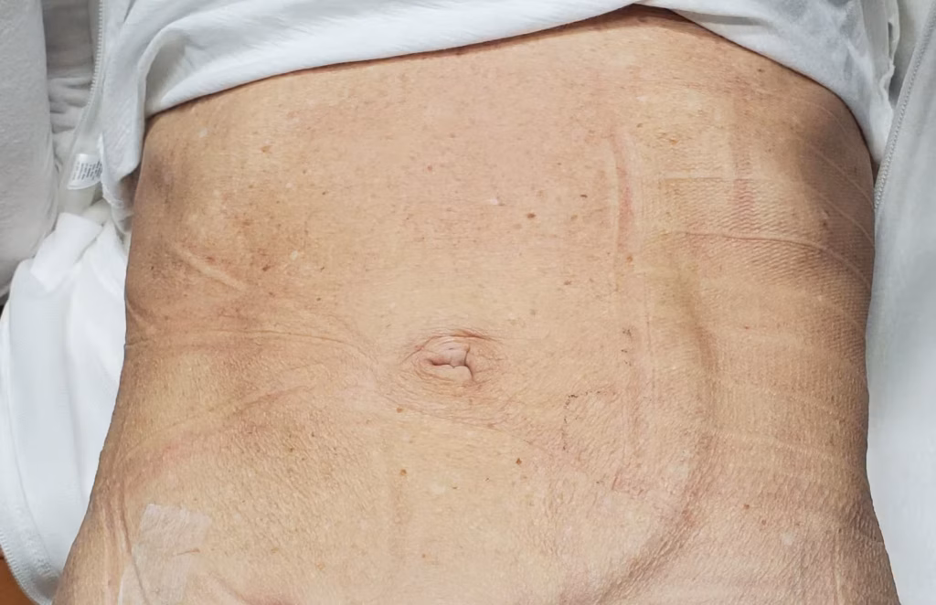 Diastasis Recti Repair Surgery in NYC 2 20201028 140407.jpg
