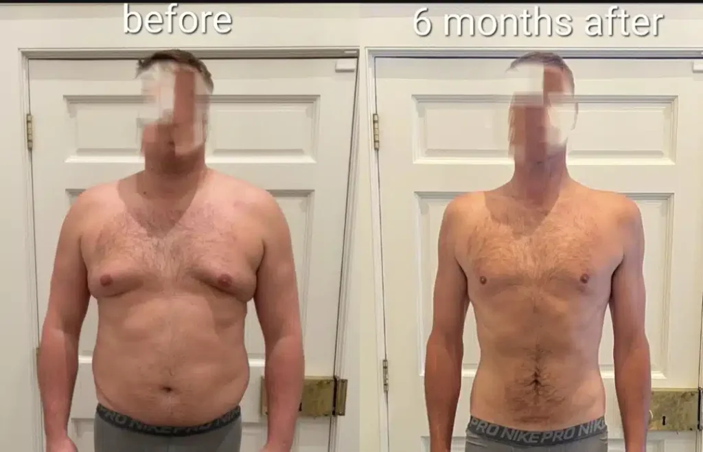Sleeve Gastrectomy in NYC 1 BeforeAfter weight loss surgery.jpg