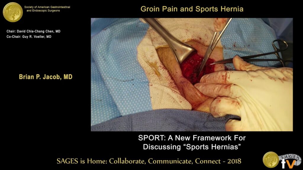 Sports Hernia Surgery in NYC 1 maxresdefault 2