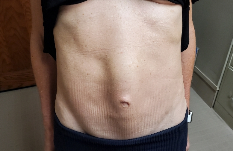 Diastasis Recti Repair Surgery in NYC 3 1 n
