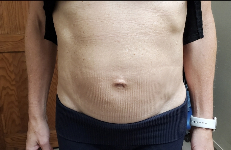 Diastasis Recti Repair Surgery in NYC 4 2 n