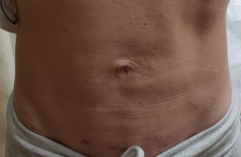 Diastasis Recti Repair Surgery in NYC 5 3 n